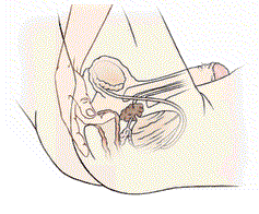 Animation of prostate stimulation