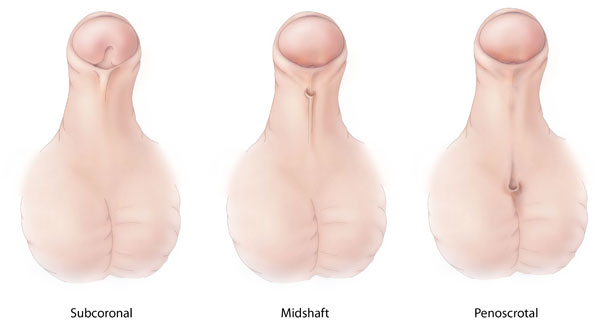 illustration of hypospadias